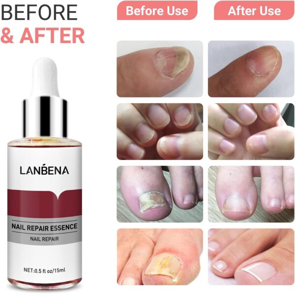 LANBENA Nails Repair, Nail Treatment Nail Care Serum Protect Nail - Image 3