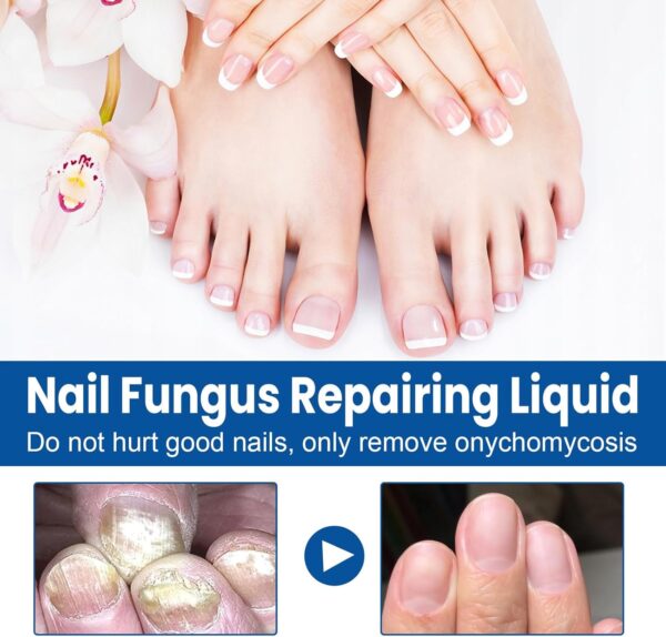 AXIYIBZI Nail Repair, Fingernail and Toenail Repair - Image 2